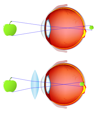 Diagram of hyperopia and lens correction using a biconvex lens/Diagramme de l’hypermétropie et de la correction avec une lentille biconvexe