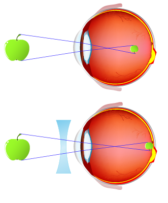 Diagram of myopia and lens correction with a biconcave lens/Diagramme de la correction de la myopie par une lentille biconcave