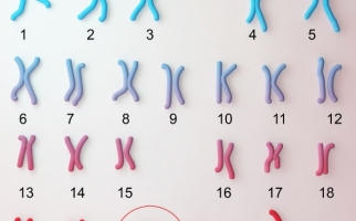 Down Syndrome karyotype