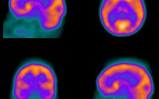 Medical image of the brain using Technetium-99m
