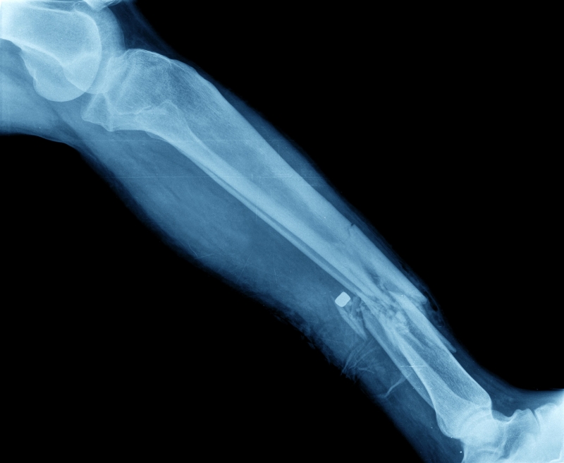 X-ray image of a broken leg 