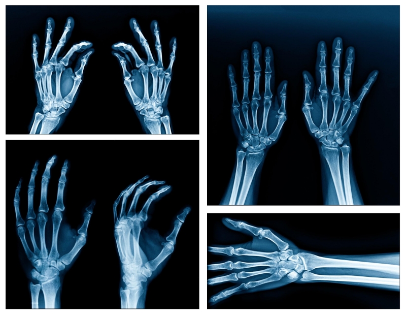 Wrist and hand x-rays 