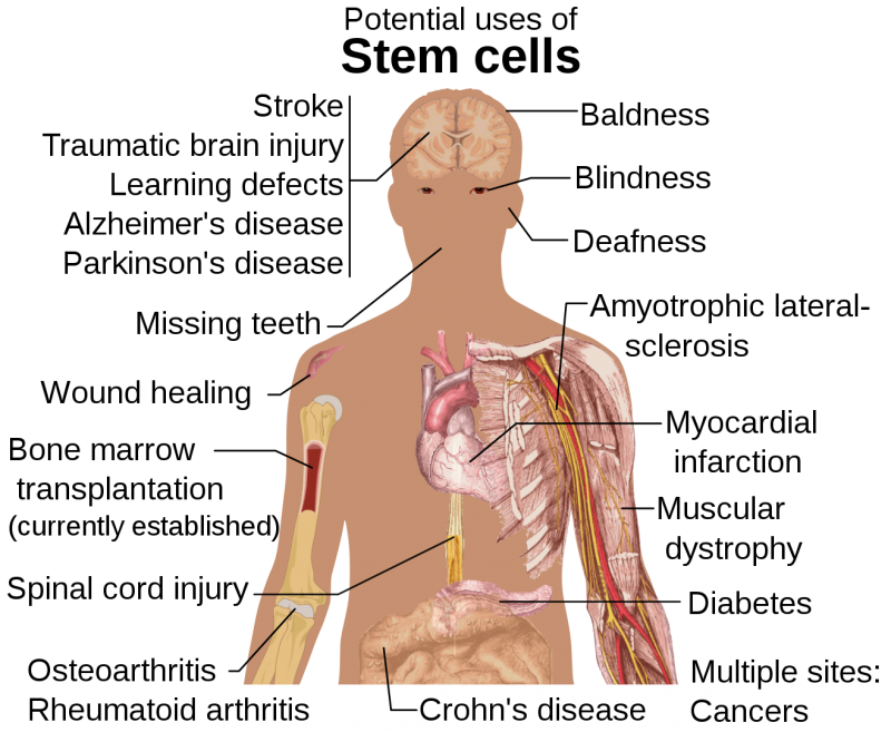 Diseases and conditions where stem cell treatment is being investigated