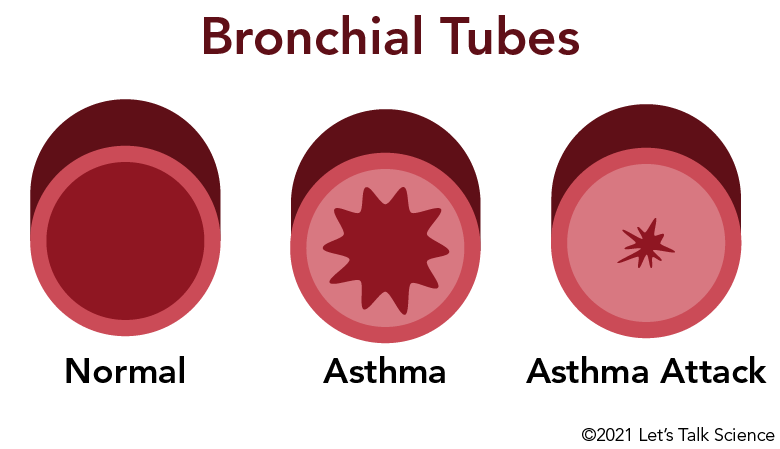 Normal and inflamed bronchial tubes