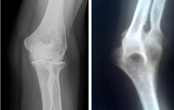 Image non-fused elbow bones on the left and fused elbow bones on the right