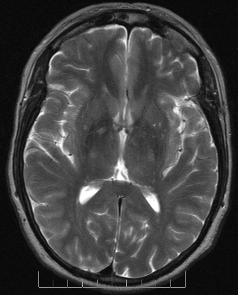 MRI image of a human brain