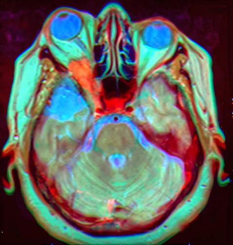 Colour-enhanced MRI image of the brain, optic nerves and eyes