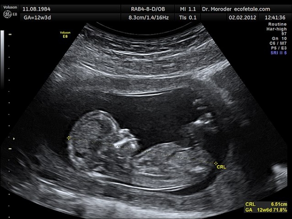 Ultrasound image of a fetus in the womb (12 weeks of pregnancy)