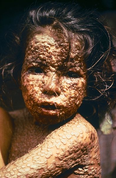 Child with smallpox in Bangladesh, 1977