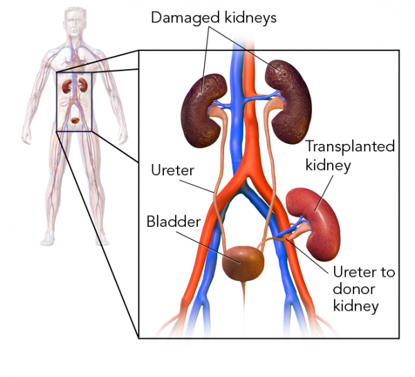 The transplanted kidney is attached to the renal artery and veins and via a new ureter to the bladder