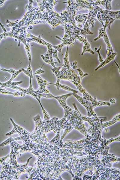 Closeup of prostate cancer cells
